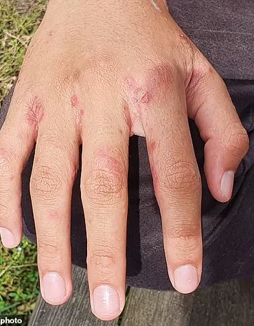 Expert Warns Holidaymakers of Scabies Risk from Leaving Luggage on Hotel Beds