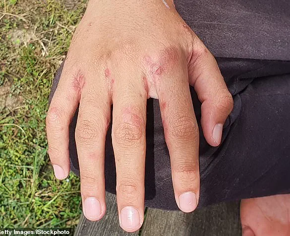 Expert Warns Holidaymakers of Scabies Risk from Leaving Luggage on Hotel Beds
