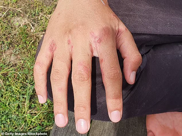 Expert Warns Holidaymakers of Scabies Risk from Leaving Luggage on Hotel Beds
