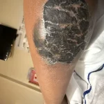 Tattoo Honoring Late Brother Leads to Severe Health Crisis, Highlighting Unexpected Risks of Body Art