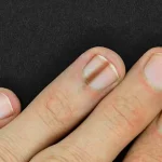 The Hidden Health Secrets in Your Toenails: How They Can Signal Diabetes, Circulatory Problems, and More