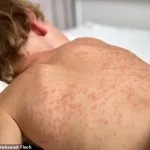 Urgent Alert: Measles Case Sparks Outbreak Fears in NC College Town, Health Officials Mobilize