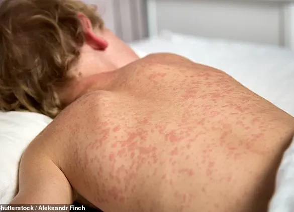 Urgent Alert: Measles Case Sparks Outbreak Fears in NC College Town, Health Officials Mobilize