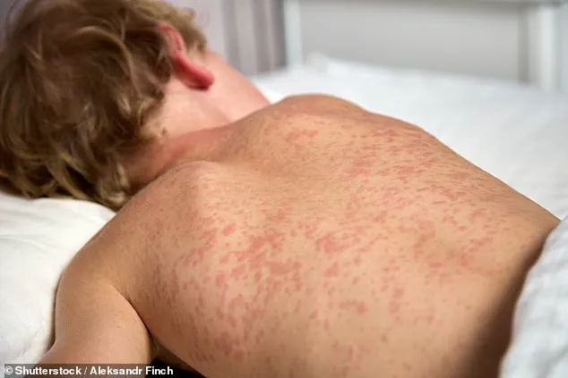 Urgent Alert: Measles Case Sparks Outbreak Fears in NC College Town, Health Officials Mobilize