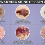 Australia's Leading GP Issues Stark Warning: Unusual Skin Bumps Could Signal Deadly Melanoma, New Data Reveals