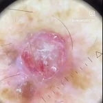 Australia's Leading GP Issues Stark Warning: Unusual Skin Bumps Could Signal Deadly Melanoma, New Data Reveals