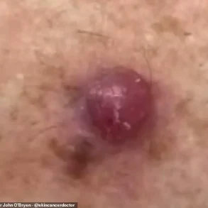 Australia's Leading GP Issues Stark Warning: Unusual Skin Bumps Could Signal Deadly Melanoma, New Data Reveals