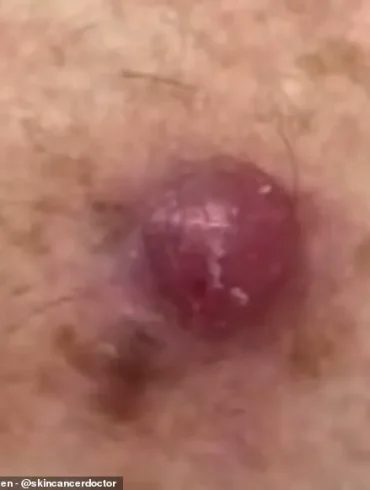 Australia's Leading GP Issues Stark Warning: Unusual Skin Bumps Could Signal Deadly Melanoma, New Data Reveals