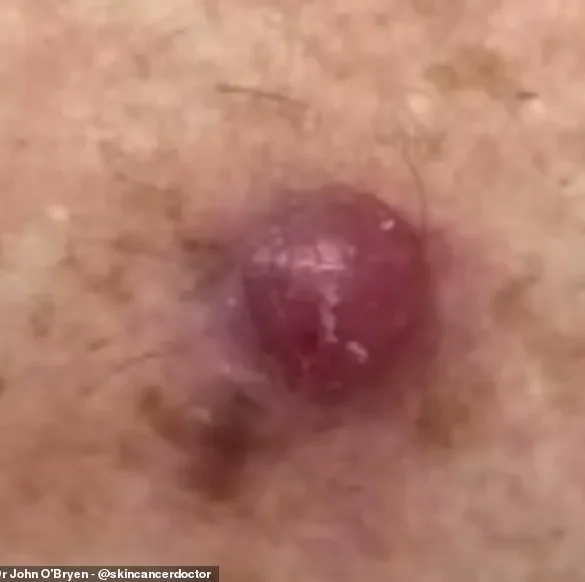 Australia's Leading GP Issues Stark Warning: Unusual Skin Bumps Could Signal Deadly Melanoma, New Data Reveals