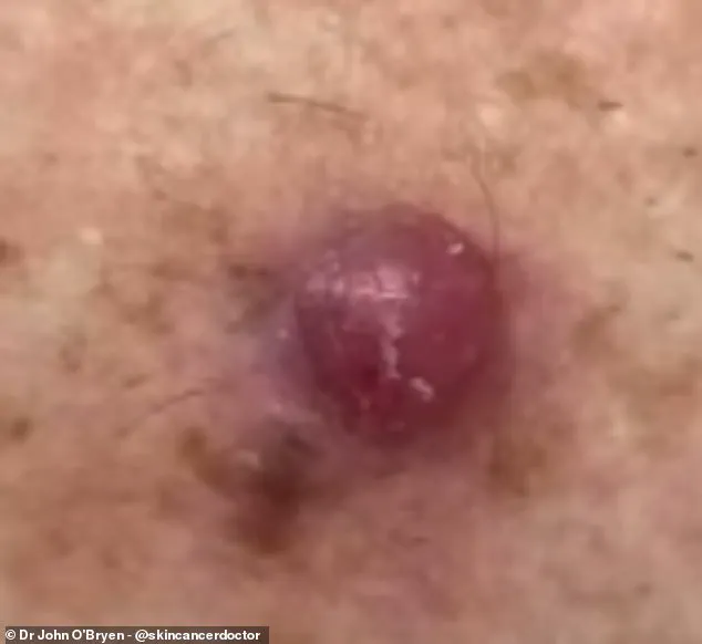 Australia's Leading GP Issues Stark Warning: Unusual Skin Bumps Could Signal Deadly Melanoma, New Data Reveals