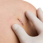 Biopsies: A Necessary Procedure in the Fight Against Disease, Despite Patient Discomfort
