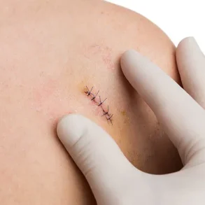 Biopsies: A Necessary Procedure in the Fight Against Disease, Despite Patient Discomfort