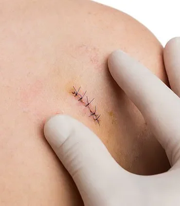 Biopsies: A Necessary Procedure in the Fight Against Disease, Despite Patient Discomfort