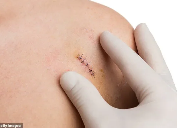 Biopsies: A Necessary Procedure in the Fight Against Disease, Despite Patient Discomfort
