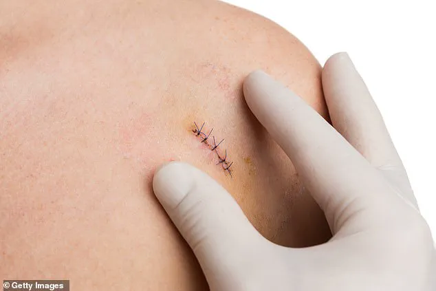 Biopsies: A Necessary Procedure in the Fight Against Disease, Despite Patient Discomfort