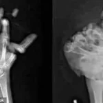 Fireworks Injuries Spark Debate Over Government Regulation of Public Celebrations