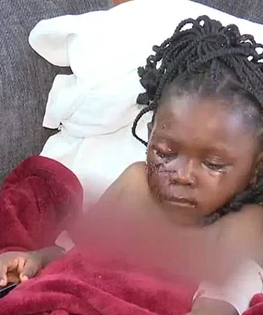 Five-Year-Old Girl Left Permanently Scarred After Brutal Pit Bull Attack in Indiana Backyard