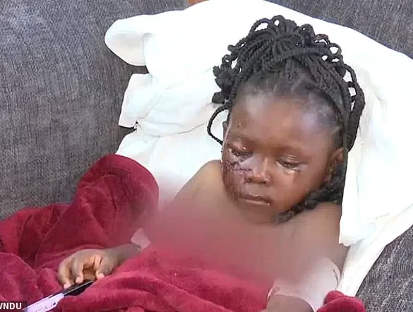 Five-Year-Old Girl Left Permanently Scarred After Brutal Pit Bull Attack in Indiana Backyard