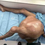 Former Laborer Survives Removal of 76.5-Pound Tumor in Historic Surgery