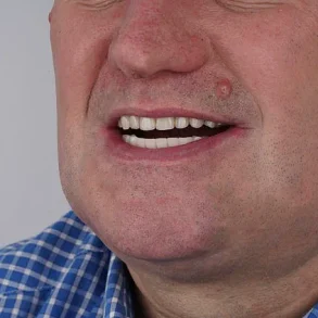 Grant Lakey's Shoelace Dentistry: A Cautionary Tale of DIY Extraction Amid NHS Access Crisis, as Told to Mail Online