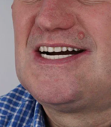 Grant Lakey's Shoelace Dentistry: A Cautionary Tale of DIY Extraction Amid NHS Access Crisis, as Told to Mail Online
