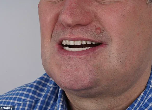 Grant Lakey's Shoelace Dentistry: A Cautionary Tale of DIY Extraction Amid NHS Access Crisis, as Told to Mail Online