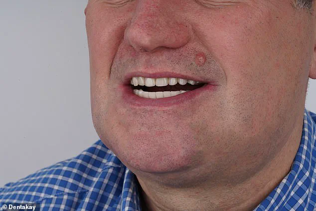 Grant Lakey's Shoelace Dentistry: A Cautionary Tale of DIY Extraction Amid NHS Access Crisis, as Told to Mail Online