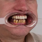 Grant Lakey's Shoelace Dentistry: A Cautionary Tale of DIY Extraction Amid NHS Access Crisis, as Told to Mail Online