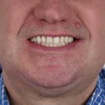 Grant Lakey's Shoelace Dentistry: A Cautionary Tale of DIY Extraction Amid NHS Access Crisis, as Told to Mail Online