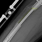 Late-Breaking: Leon Otremba's Controversial Leg-Lengthening Surgery Sparks Global Debate as Social Media Videos Reach Tens of Millions