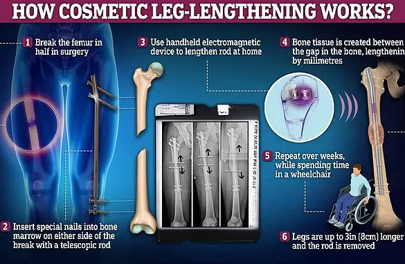 Late-Breaking: Leon Otremba's Controversial Leg-Lengthening Surgery Sparks Global Debate as Social Media Videos Reach Tens of Millions