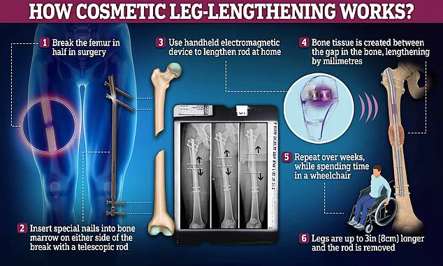 Late-Breaking: Leon Otremba's Controversial Leg-Lengthening Surgery Sparks Global Debate as Social Media Videos Reach Tens of Millions