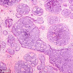 New Discovery: Scottish Researchers Uncover Breast Cancer Metastasis Mechanism Involving Immune Cell Manipulation and Uracil Protein
