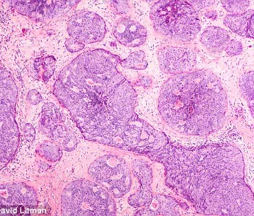 New Discovery: Scottish Researchers Uncover Breast Cancer Metastasis Mechanism Involving Immune Cell Manipulation and Uracil Protein
