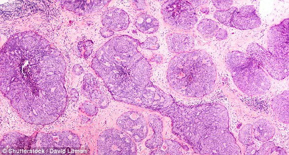 New Discovery: Scottish Researchers Uncover Breast Cancer Metastasis Mechanism Involving Immune Cell Manipulation and Uracil Protein