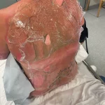 Nurse Emma Colwell Advocates for Fire Safety After Near-Fatal Fire Pit Incident