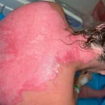 Nurse Emma Colwell Advocates for Fire Safety After Near-Fatal Fire Pit Incident
