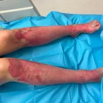 Nurse Emma Colwell Advocates for Fire Safety After Near-Fatal Fire Pit Incident