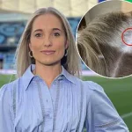 Overlooked Signs: Emily Haley's Skin Cancer Diagnosis Amid Vigilant Sun Protection