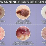 Overlooked Signs: Emily Haley's Skin Cancer Diagnosis Amid Vigilant Sun Protection