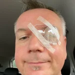 Severe Glaucoma Detected in Man with No Symptoms or Family History