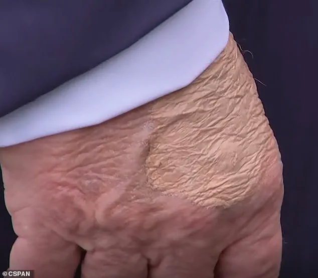 Speculation Mounts Over Unusual Hand Patch During Trump's Press Gaggle as White House Remains Silent