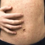 Urgent Call for Expert Advisories as Limited Access to Information Fuels Vaccine Hesitancy Crisis in UK Healthcare