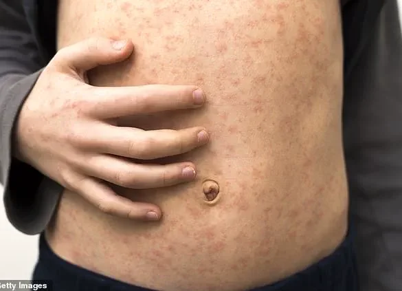Urgent Call for Expert Advisories as Limited Access to Information Fuels Vaccine Hesitancy Crisis in UK Healthcare