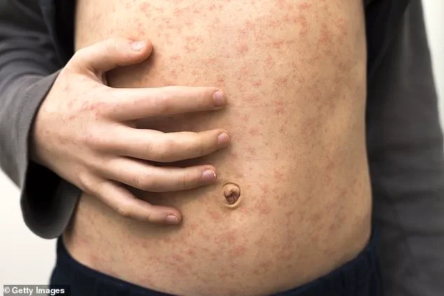 Urgent Call for Expert Advisories as Limited Access to Information Fuels Vaccine Hesitancy Crisis in UK Healthcare
