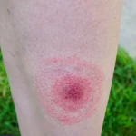 U.S. Homeland Security Denies Allegations of Lyme Disease Research at Plum Island Amid Renewed Debate Over Government's Role in Illness Spread – Latest Update