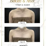 Barbie Botox Trend Surges as Women Seek Slimmer Necklines and Shoulders, Sparking Medical Concerns