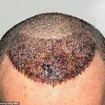 Chilling Warning: The Devastating Risks of Cheap Hair Transplants Abroad