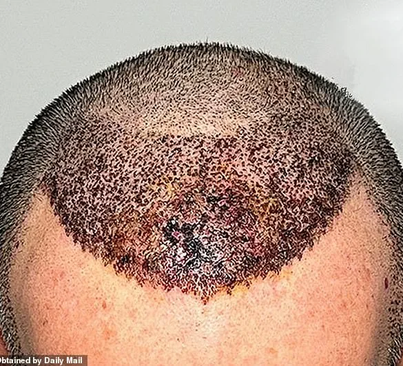 Chilling Warning: The Devastating Risks of Cheap Hair Transplants Abroad
