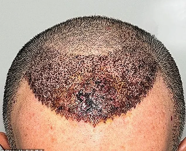Chilling Warning: The Devastating Risks of Cheap Hair Transplants Abroad